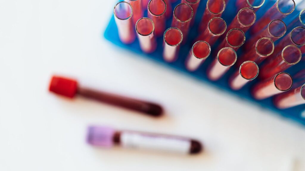 Blood sample tubes in a laboratory rack for HIV, kidney and hepatitis B tests before PrEP