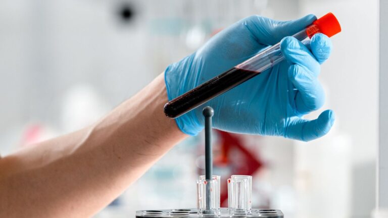 Laboratory technician holding a blood sample tube for an antigen/antibody HIV test