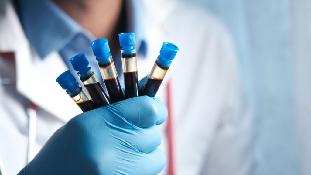 Laboratory technician holding blood sample tubes for routine kidney tests during PrEP
