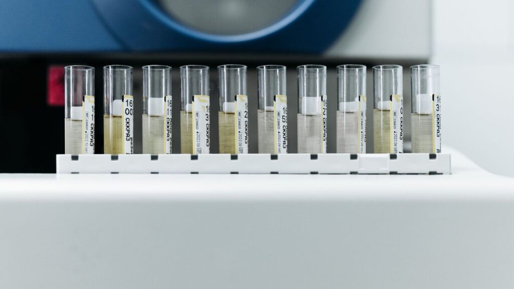 Laboratory test tubes in a rack, ready for an HIV test after a possible exposure